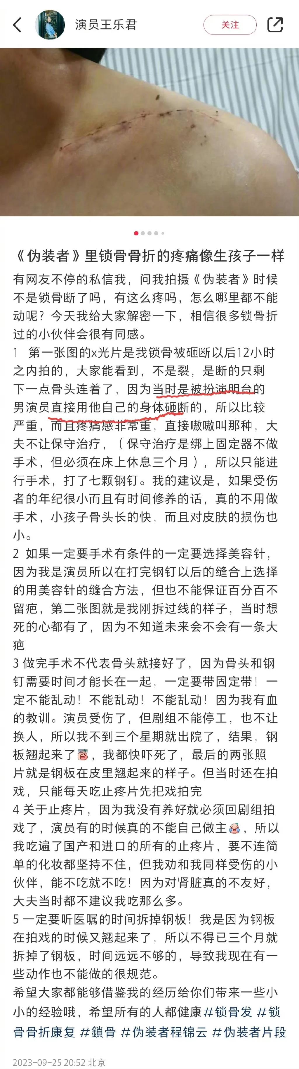 王乐君自曝拍戏时被胡歌砸断锁骨 事后自己找医院手术