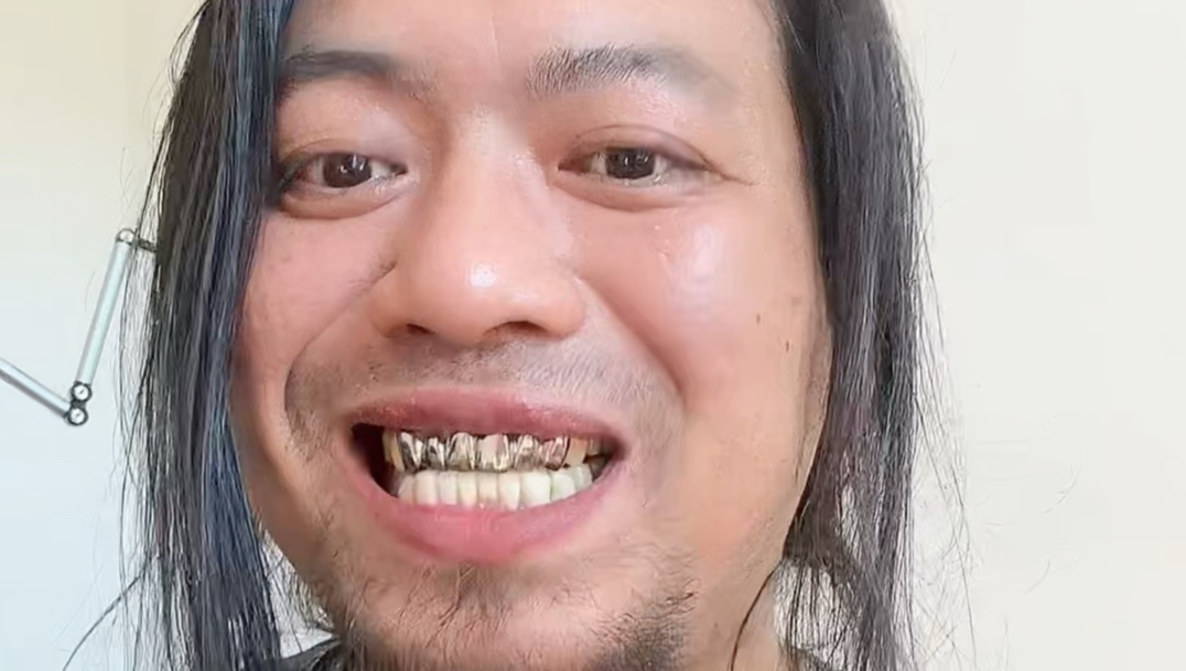 弄了口大钢牙