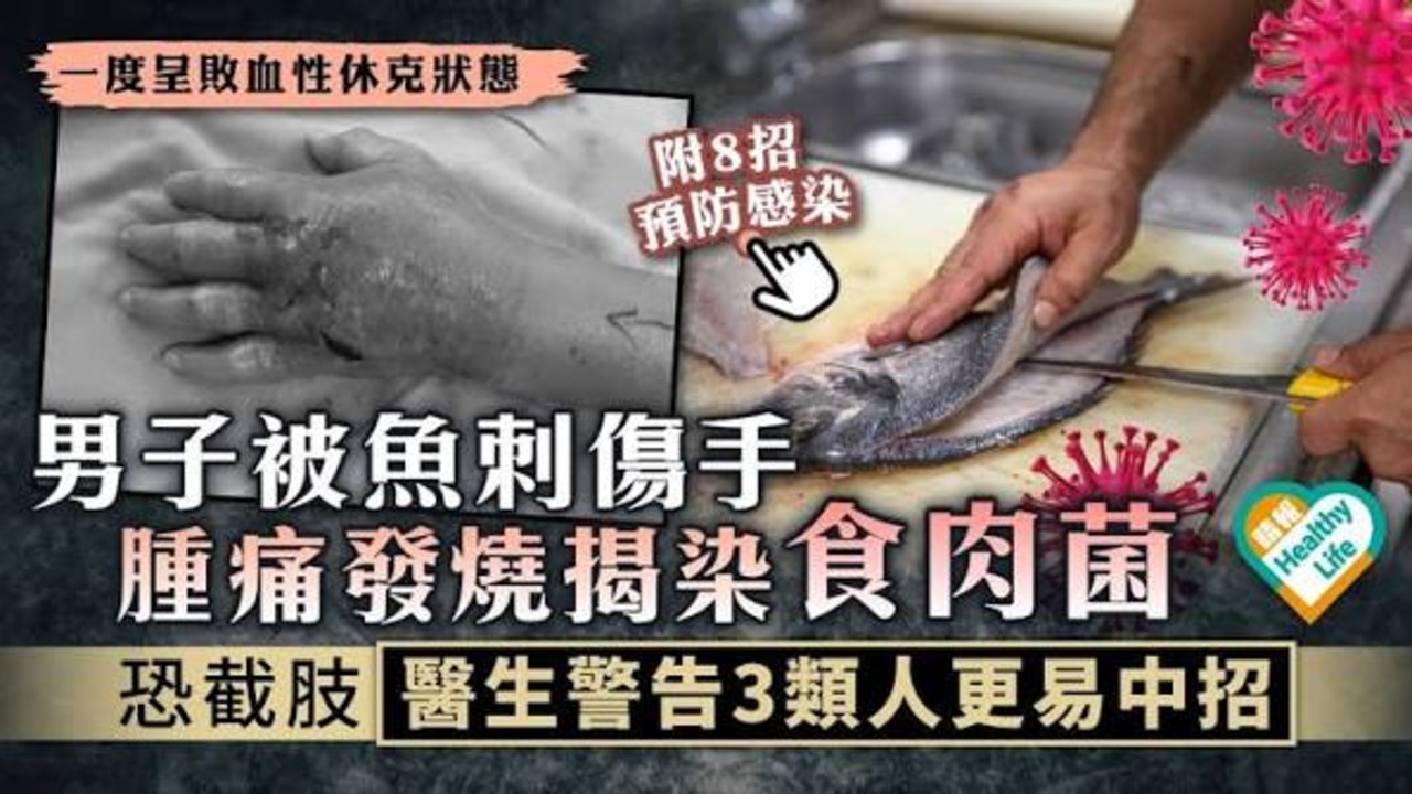 男子被鱼扎伤高烧39度感染食肉菌